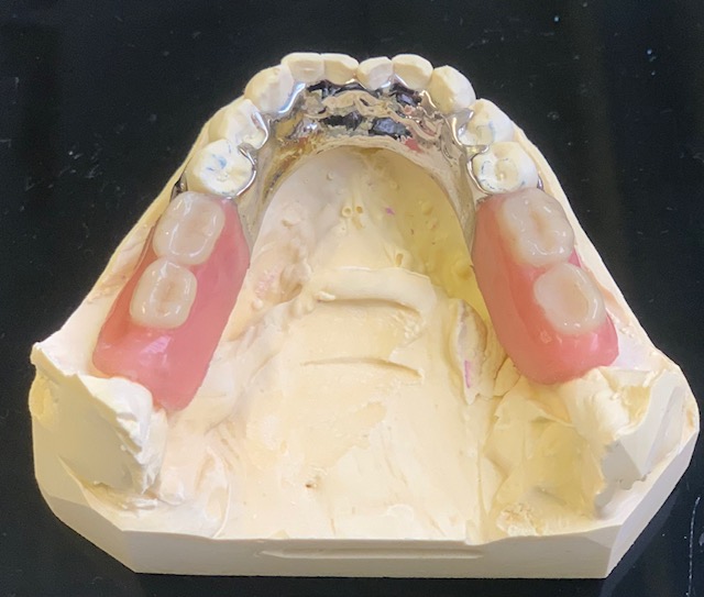 Softbase low 4 tooth CC denture